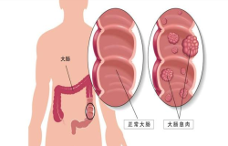 腸息肉會(huì)癌變嗎？腸鏡檢查出腸息肉千萬別大意！