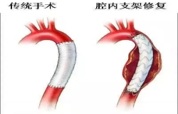 《問心》熱播！全網(wǎng)熱議的主動脈夾層，您了解嗎？