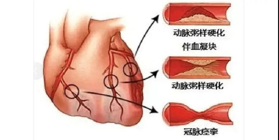 冠心病患者注意了，專(zhuān)業(yè)醫(yī)生為您盤(pán)點(diǎn)那些堅(jiān)決不能停的藥！